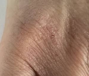 Creating a Barrier-Repair Formula My 8-Week Experiment Close-up of dry, compromised skin on hand showing visible barrier damage