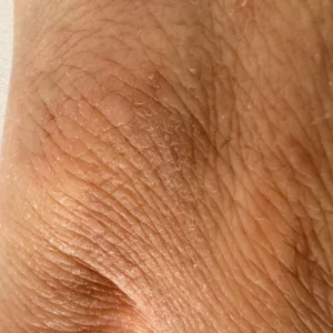 Dry, scaling skin on hand at week three of ceramide barrier-repair experiment in menopausal skin — late December.