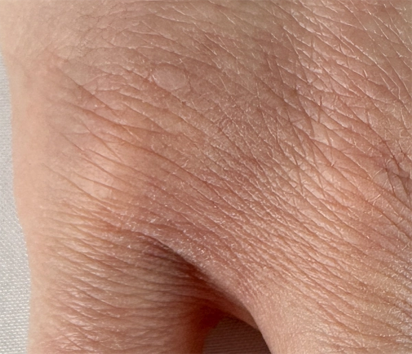 Ceramide Barrier Repair at Week Eight Hand skin at week 8 showing smooth, normal texture — February, after 8 weeks of ceramide barrier repair.