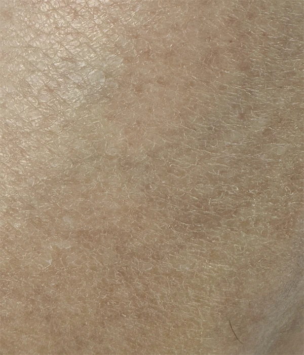 Ceramide Barrier Repair at Week Eight Shin skin at week 8 with resolved scaling and normal texture — February, after ceramide barrier repair.