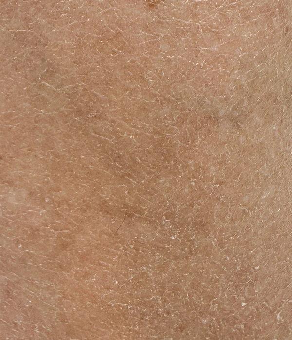 Ceramide Barrier Repair at Week Eight Shin skin at baseline with visible white scaling — December, before barrier repair protocol.