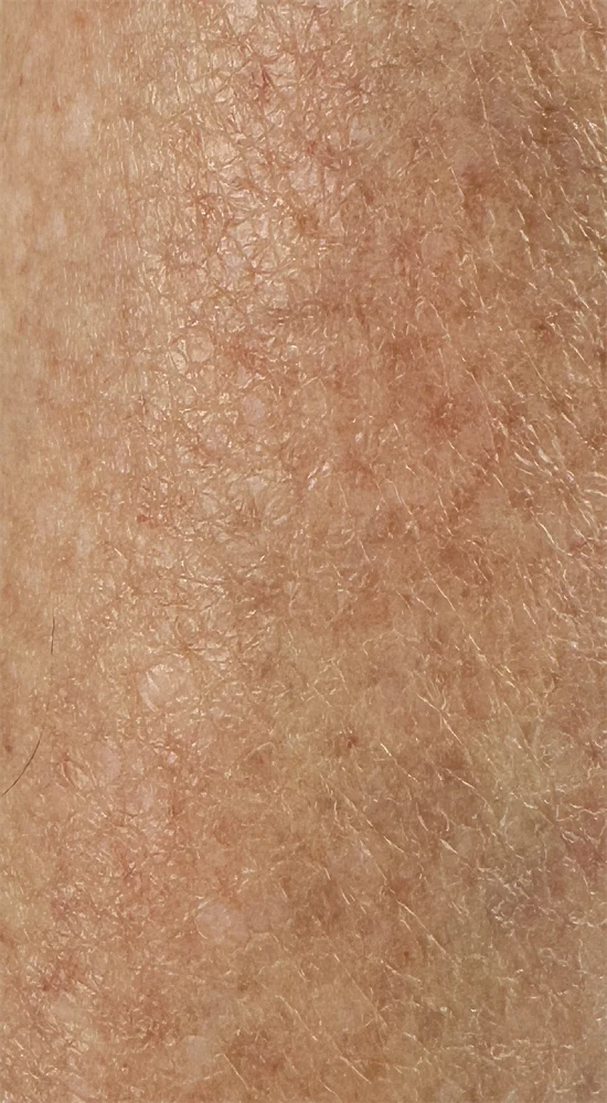Skin Barrier Repair at Week 6: What Real Progress Looks Like Shin skin texture at mid-point of barrier repair experiment showing gradual improvement